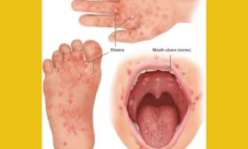 BVI Reports Spike in Hand, Foot & Mouth Disease Cases